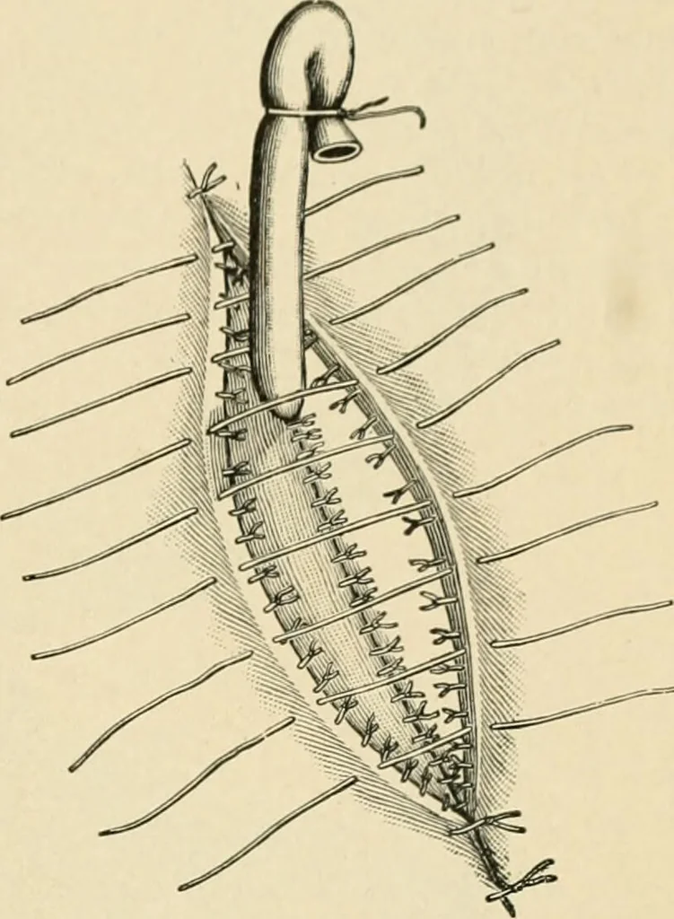 An illustration from The principles and practice of modern surgery / by Roswell Park ... with 722 engravings and 60 full-page plates in colors and monochrome., 1907, leaf 907