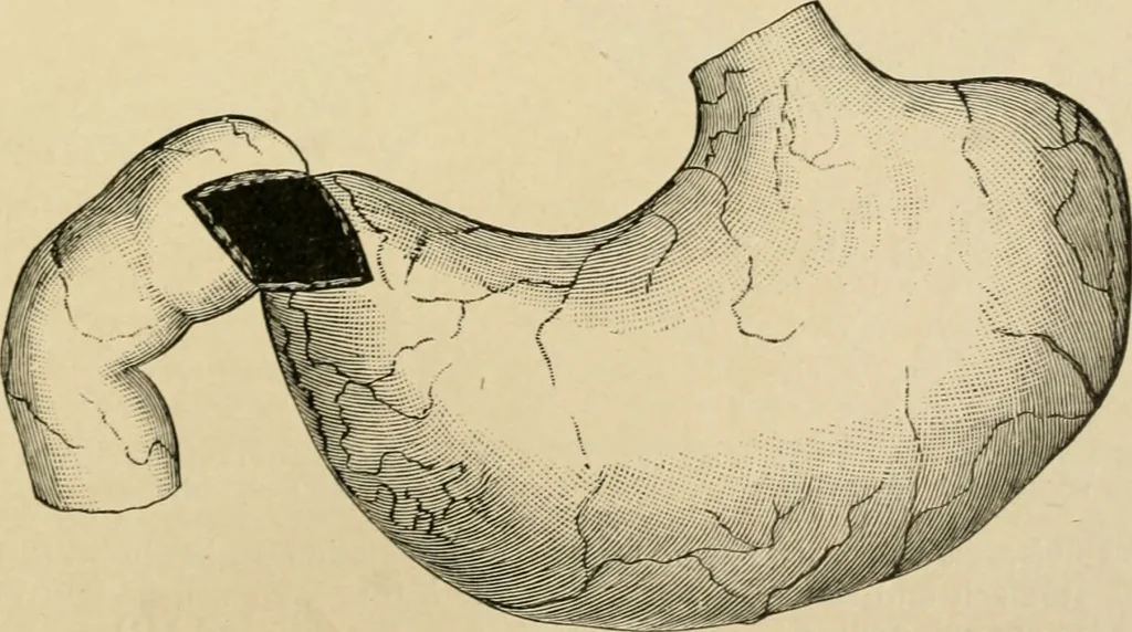 An illustration from The principles and practice of modern surgery / by Roswell Park ... with 722 engravings and 60 full-page plates in colors and monochrome., 1907, leaf 909