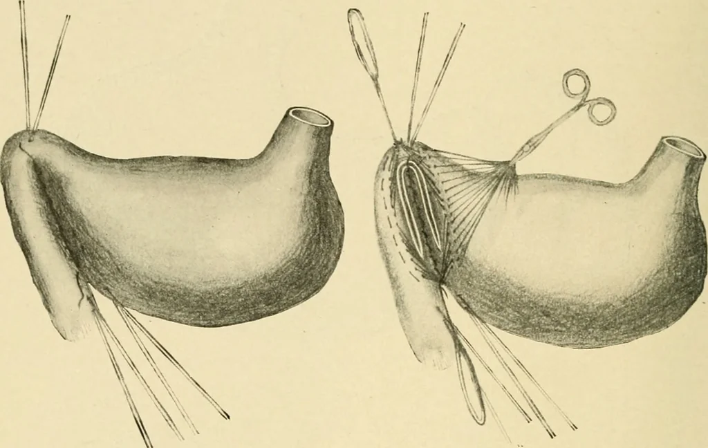 An illustration from The principles and practice of modern surgery / by Roswell Park ... with 722 engravings and 60 full-page plates in colors and monochrome., 1907, leaf 910