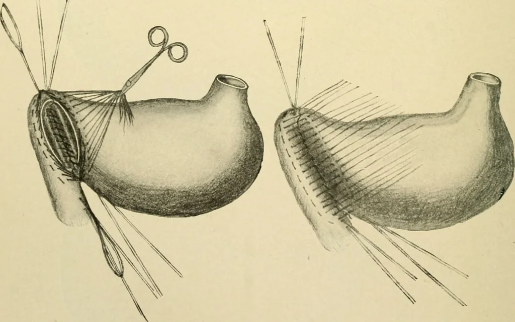 An illustration from The principles and practice of modern surgery / by Roswell Park ... with 722 engravings and 60 full-page plates in colors and monochrome., 1907, leaf 910