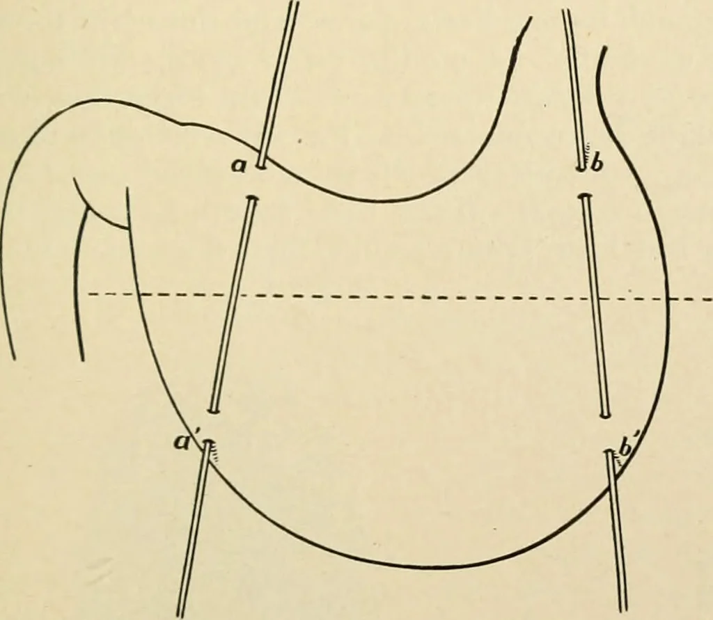 An illustration from The principles and practice of modern surgery / by Roswell Park ... with 722 engravings and 60 full-page plates in colors and monochrome., 1907, leaf 911