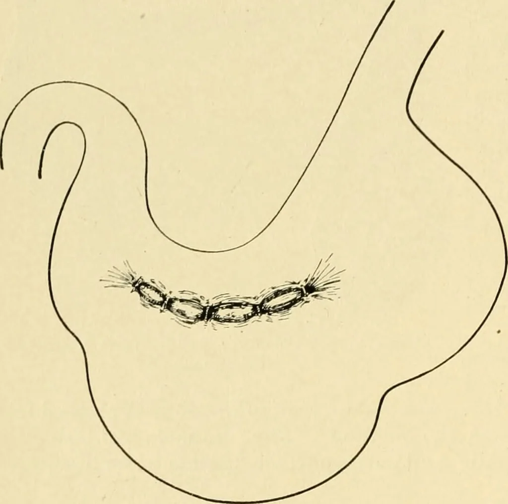 An illustration from The principles and practice of modern surgery / by Roswell Park ... with 722 engravings and 60 full-page plates in colors and monochrome., 1907, leaf 912