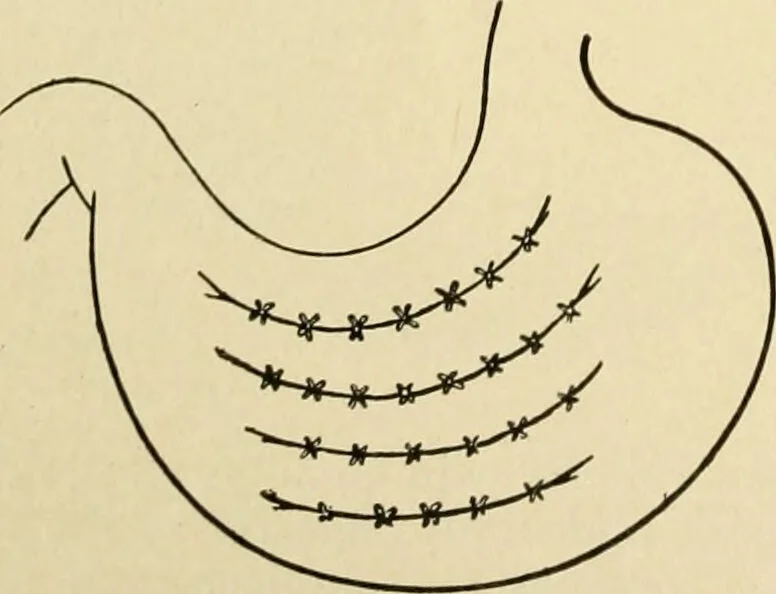 An illustration from The principles and practice of modern surgery / by Roswell Park ... with 722 engravings and 60 full-page plates in colors and monochrome., 1907, leaf 912