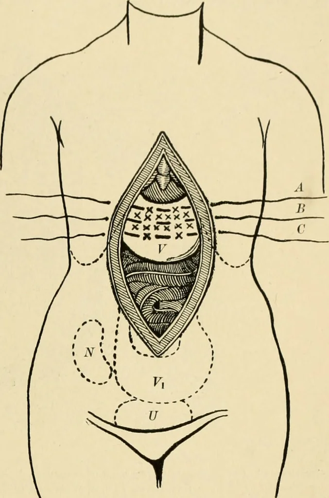 An illustration from The principles and practice of modern surgery / by Roswell Park ... with 722 engravings and 60 full-page plates in colors and monochrome., 1907, leaf 913