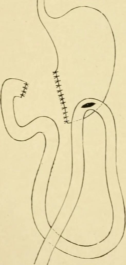 An illustration from The principles and practice of modern surgery / by Roswell Park ... with 722 engravings and 60 full-page plates in colors and monochrome., 1907, leaf 916