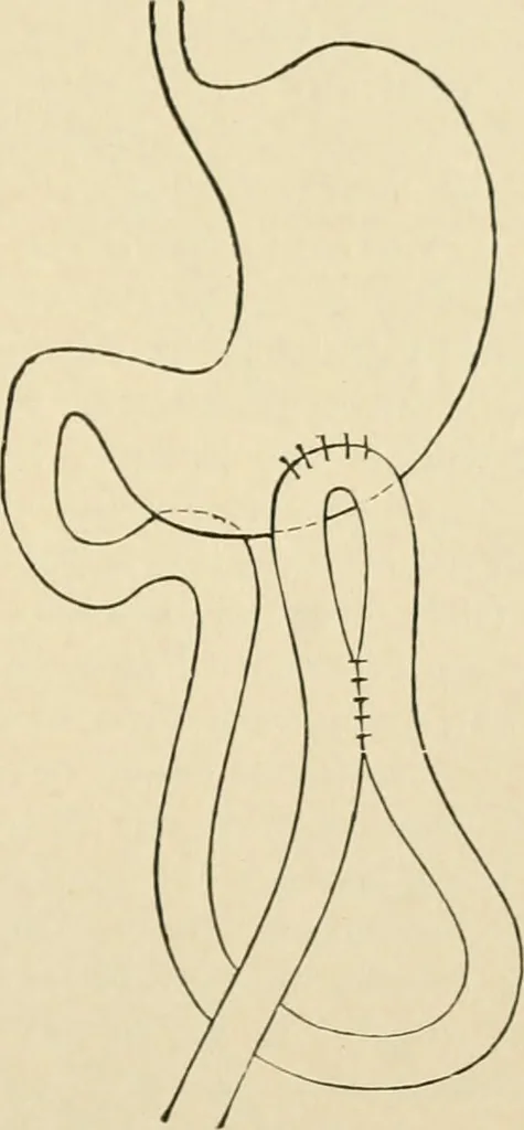 An illustration from The principles and practice of modern surgery / by Roswell Park ... with 722 engravings and 60 full-page plates in colors and monochrome., 1907, leaf 917