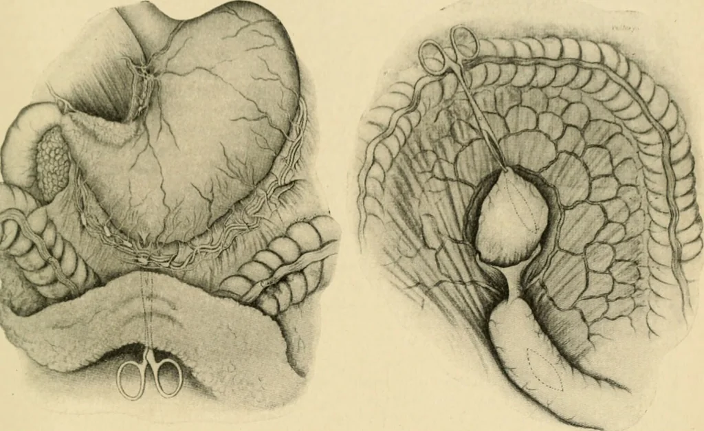 An illustration from The principles and practice of modern surgery / by Roswell Park ... with 722 engravings and 60 full-page plates in colors and monochrome., 1907, leaf 919