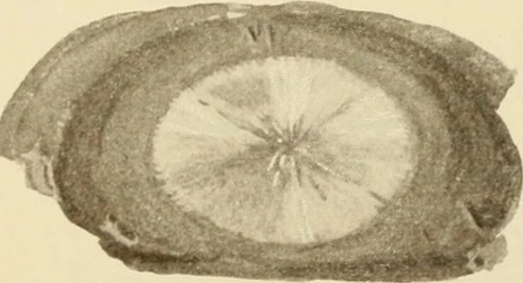 An illustration from The principles and practice of modern surgery / by Roswell Park ... with 722 engravings and 60 full-page plates in colors and monochrome., 1907, leaf 933