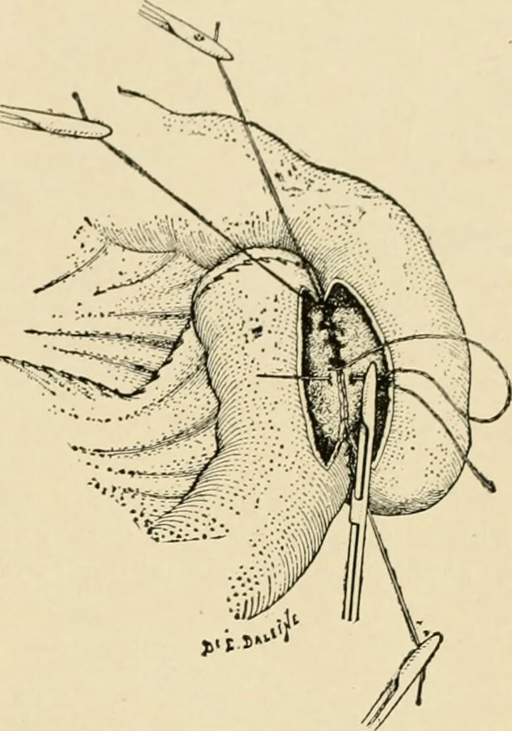 An illustration from The principles and practice of modern surgery / by Roswell Park ... with 722 engravings and 60 full-page plates in colors and monochrome., 1907, leaf 945