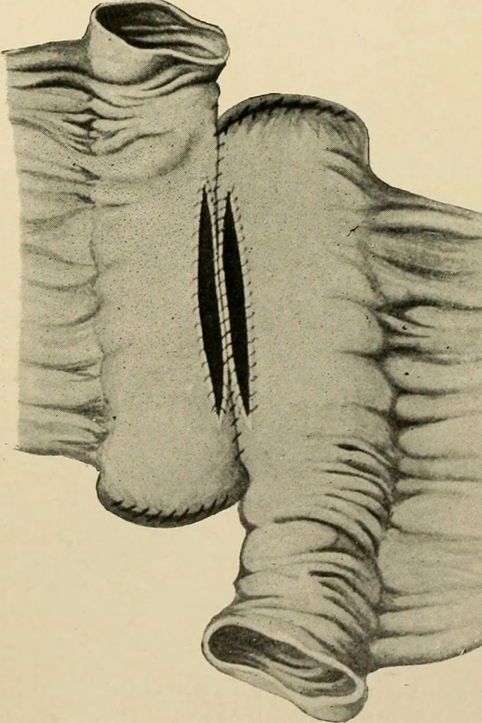 An illustration from The principles and practice of modern surgery / by Roswell Park ... with 722 engravings and 60 full-page plates in colors and monochrome., 1907, leaf 945