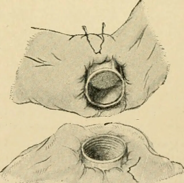 An illustration from The principles and practice of modern surgery / by Roswell Park ... with 722 engravings and 60 full-page plates in colors and monochrome., 1907, leaf 947