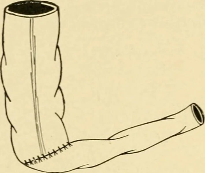 An illustration from The principles and practice of modern surgery / by Roswell Park ... with 722 engravings and 60 full-page plates in colors and monochrome., 1907, leaf 950