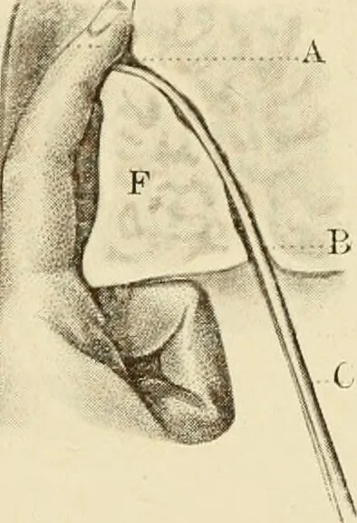 An illustration from The principles and practice of modern surgery / by Roswell Park ... with 722 engravings and 60 full-page plates in colors and monochrome., 1907, leaf 987