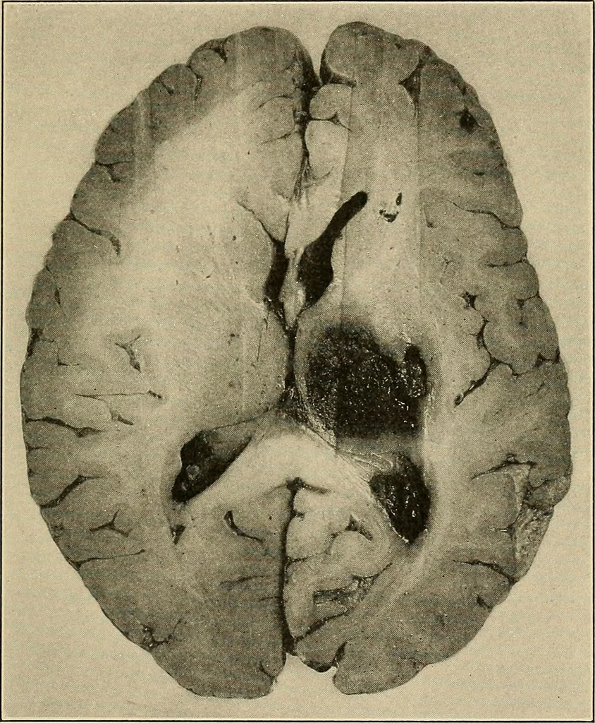 An illustration from Surgical diagnosis / by Edward Martin ... illustrated with 445 engravings and 18 plates in colors and monochrome., 1909, leaf 175