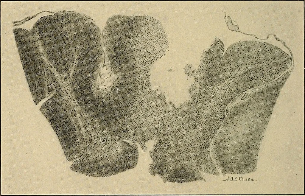 An illustration from Surgical diagnosis / by Edward Martin ... illustrated with 445 engravings and 18 plates in colors and monochrome., 1909, leaf 180