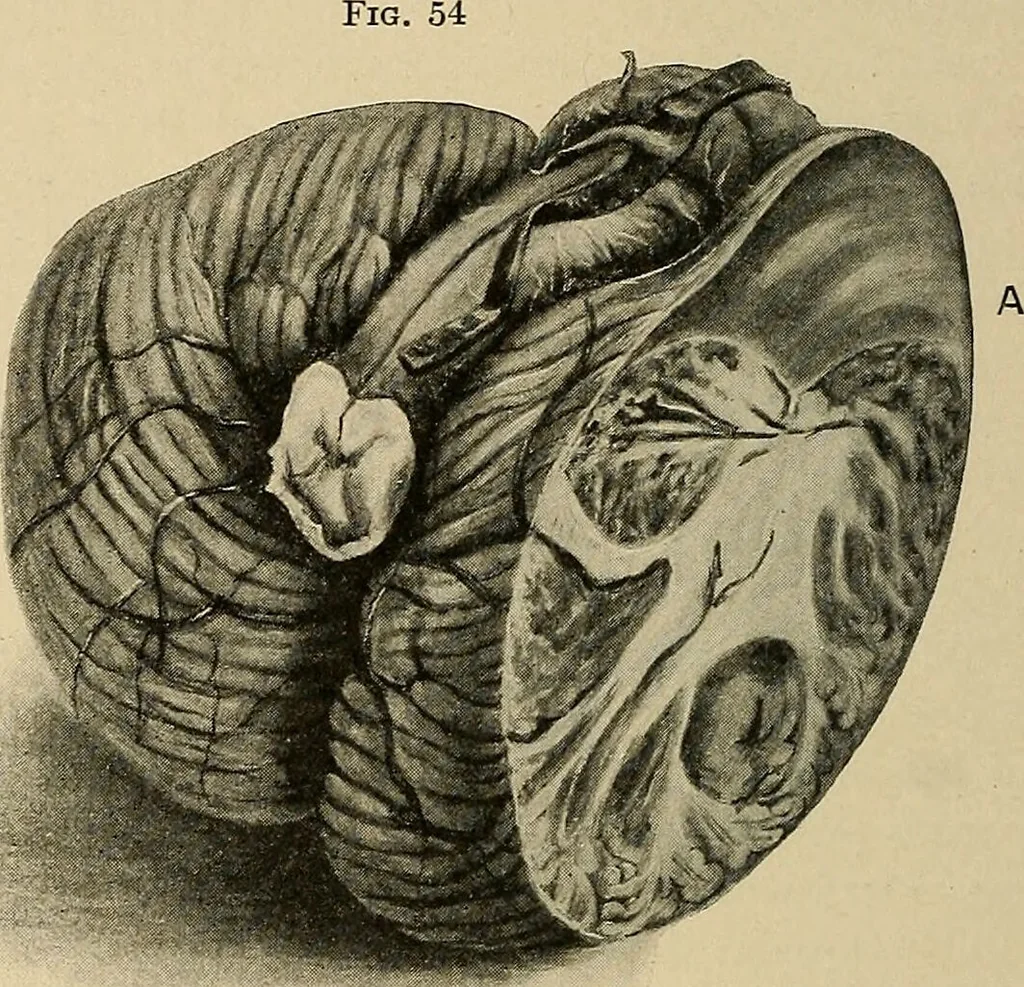 An illustration from Surgical diagnosis / by Edward Martin ... illustrated with 445 engravings and 18 plates in colors and monochrome., 1909, leaf 184