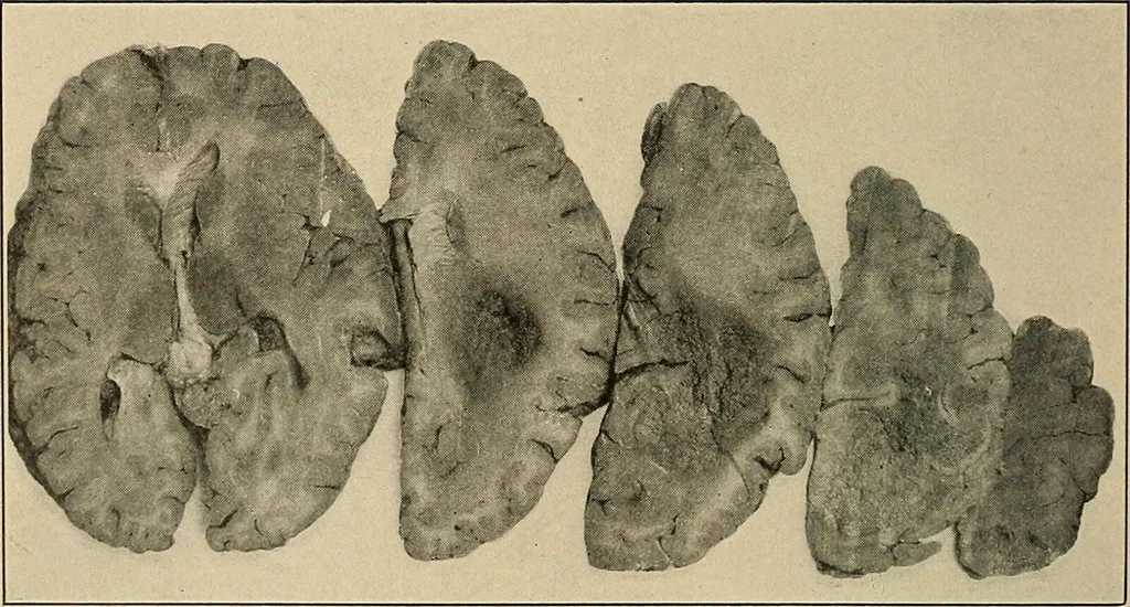 An illustration from Surgical diagnosis / by Edward Martin ... illustrated with 445 engravings and 18 plates in colors and monochrome., 1909, leaf 186