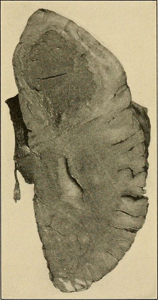 An illustration from Surgical diagnosis / by Edward Martin ... illustrated with 445 engravings and 18 plates in colors and monochrome., 1909, leaf 187