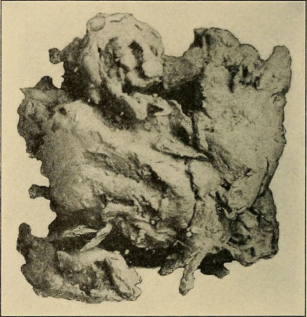 An illustration from Surgical diagnosis / by Edward Martin ... illustrated with 445 engravings and 18 plates in colors and monochrome., 1909, leaf 190