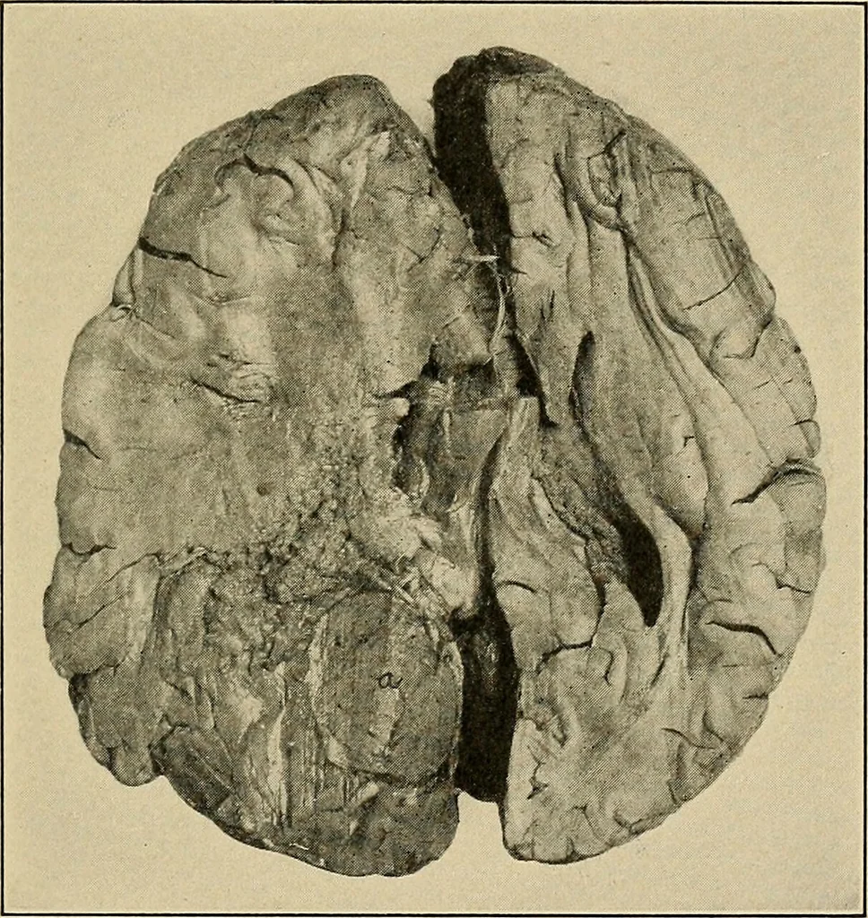 An illustration from Surgical diagnosis / by Edward Martin ... illustrated with 445 engravings and 18 plates in colors and monochrome., 1909, leaf 191