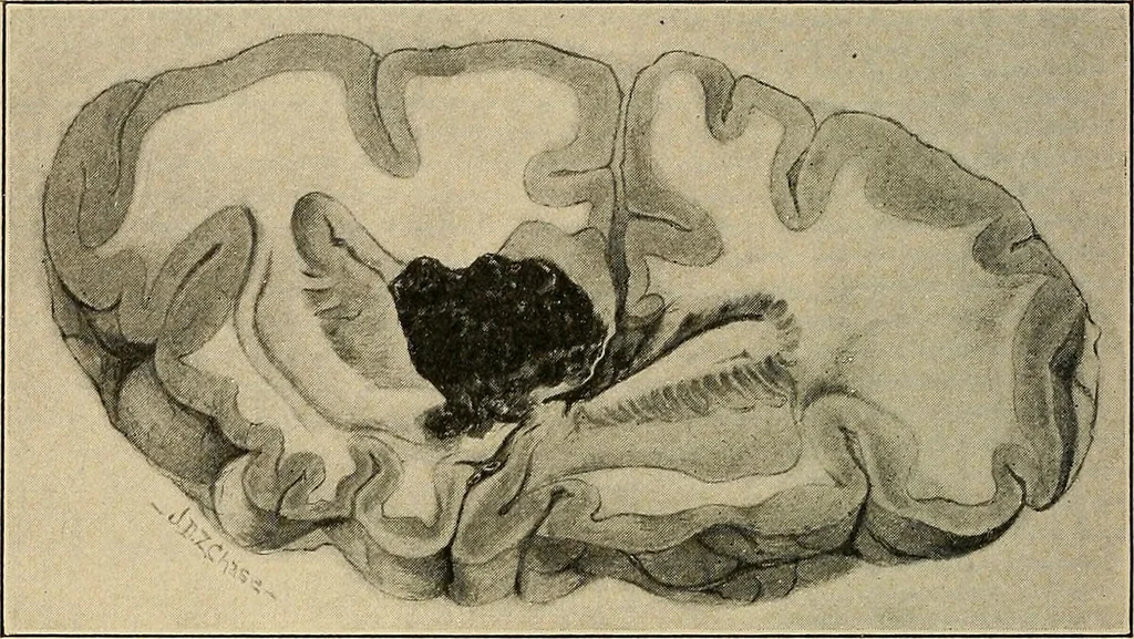 An illustration from Surgical diagnosis / by Edward Martin ... illustrated with 445 engravings and 18 plates in colors and monochrome., 1909, leaf 192