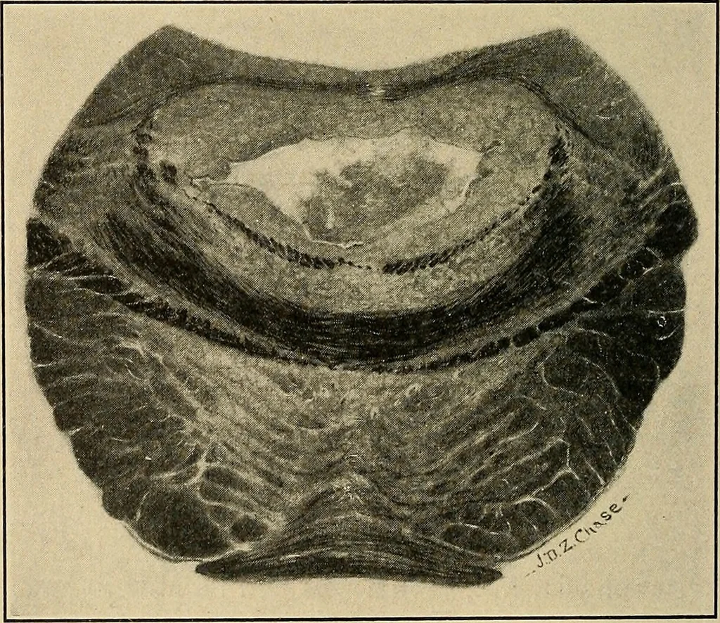 An illustration from Surgical diagnosis / by Edward Martin ... illustrated with 445 engravings and 18 plates in colors and monochrome., 1909, leaf 192