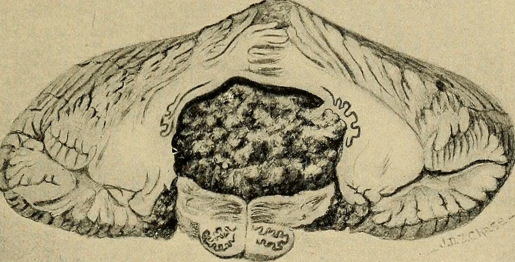 An illustration from Surgical diagnosis / by Edward Martin ... illustrated with 445 engravings and 18 plates in colors and monochrome., 1909, leaf 197
