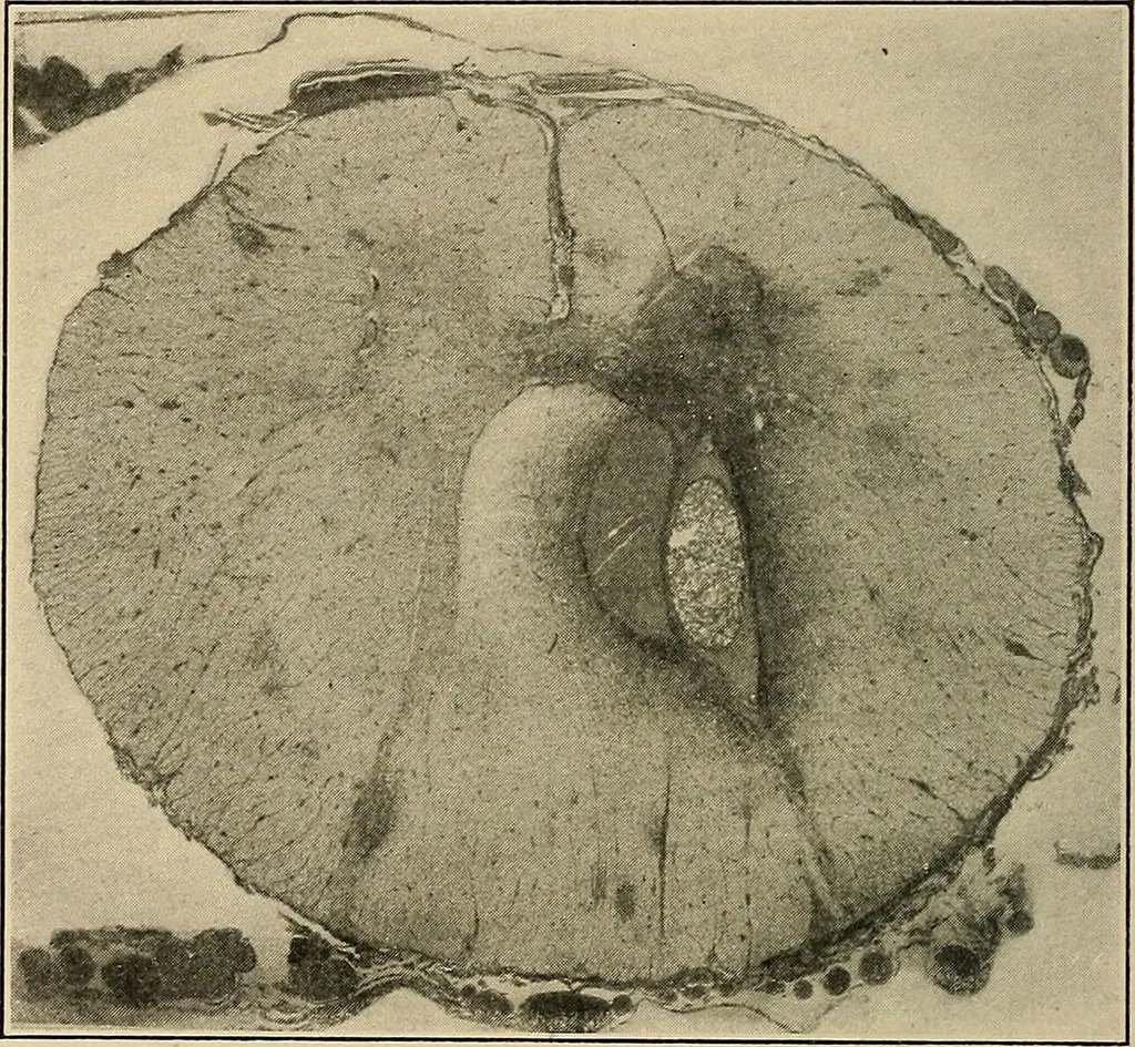 An illustration from Surgical diagnosis / by Edward Martin ... illustrated with 445 engravings and 18 plates in colors and monochrome., 1909, leaf 224