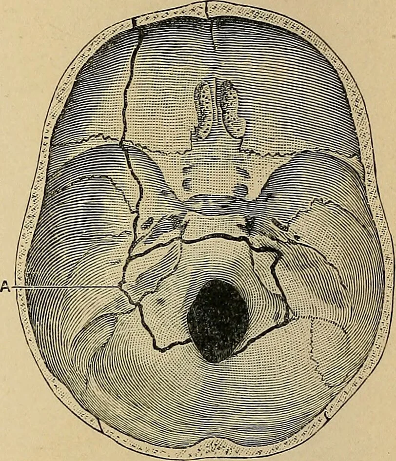 An illustration from Surgical diagnosis / by Edward Martin ... illustrated with 445 engravings and 18 plates in colors and monochrome., 1909, leaf 250