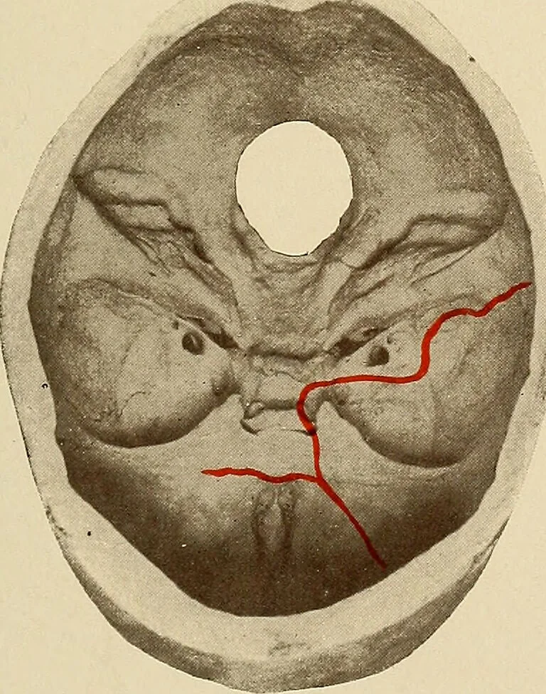 An illustration from Surgical diagnosis / by Edward Martin ... illustrated with 445 engravings and 18 plates in colors and monochrome., 1909, leaf 251
