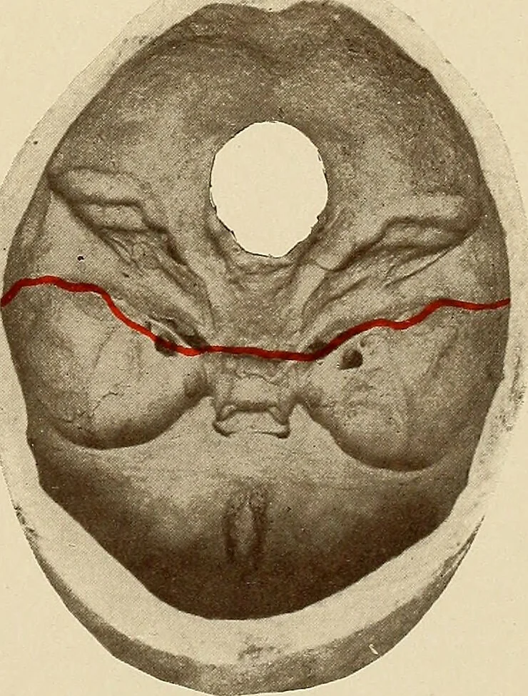 An illustration from Surgical diagnosis / by Edward Martin ... illustrated with 445 engravings and 18 plates in colors and monochrome., 1909, leaf 251