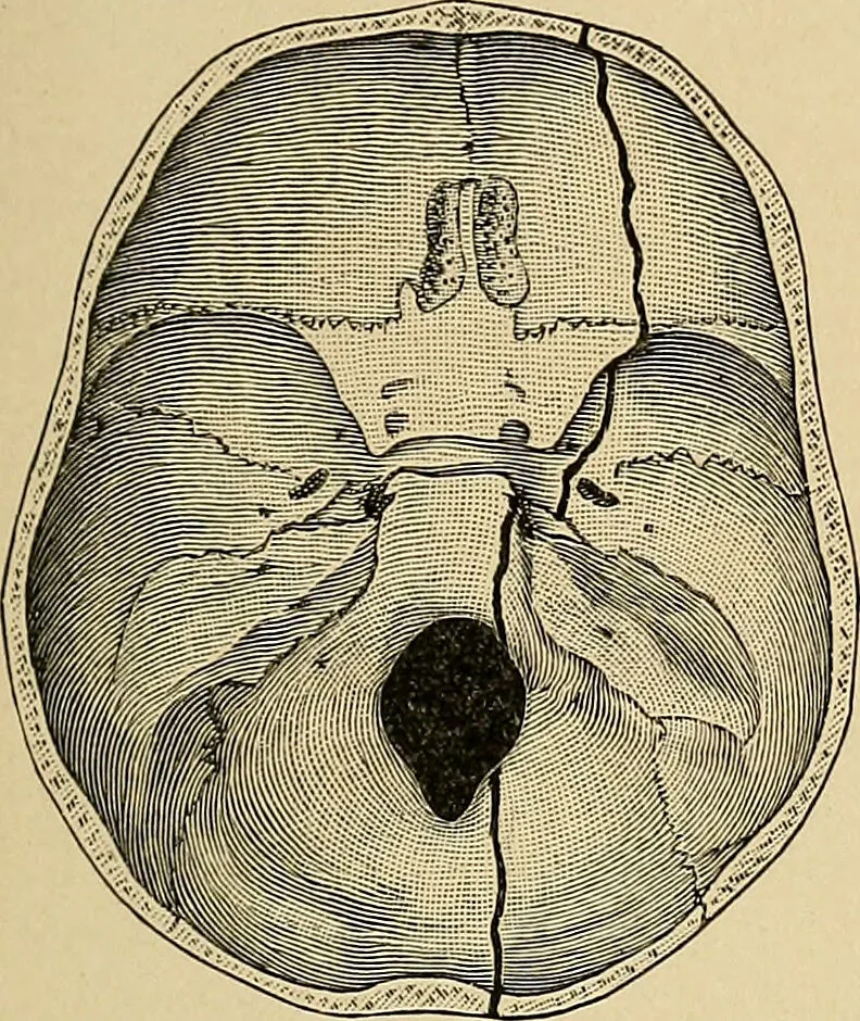 An illustration from Surgical diagnosis / by Edward Martin ... illustrated with 445 engravings and 18 plates in colors and monochrome., 1909, leaf 253