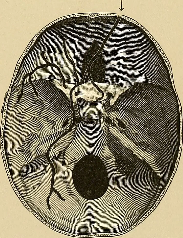 An illustration from Surgical diagnosis / by Edward Martin ... illustrated with 445 engravings and 18 plates in colors and monochrome., 1909, leaf 253