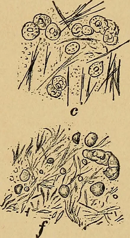 An illustration from Surgical diagnosis / by Edward Martin ... illustrated with 445 engravings and 18 plates in colors and monochrome., 1909, leaf 33