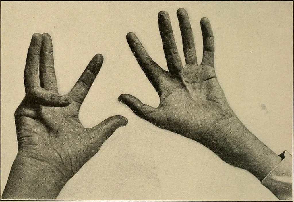 An illustration from Surgical diagnosis / by Edward Martin ... illustrated with 445 engravings and 18 plates in colors and monochrome., 1909, leaf 380