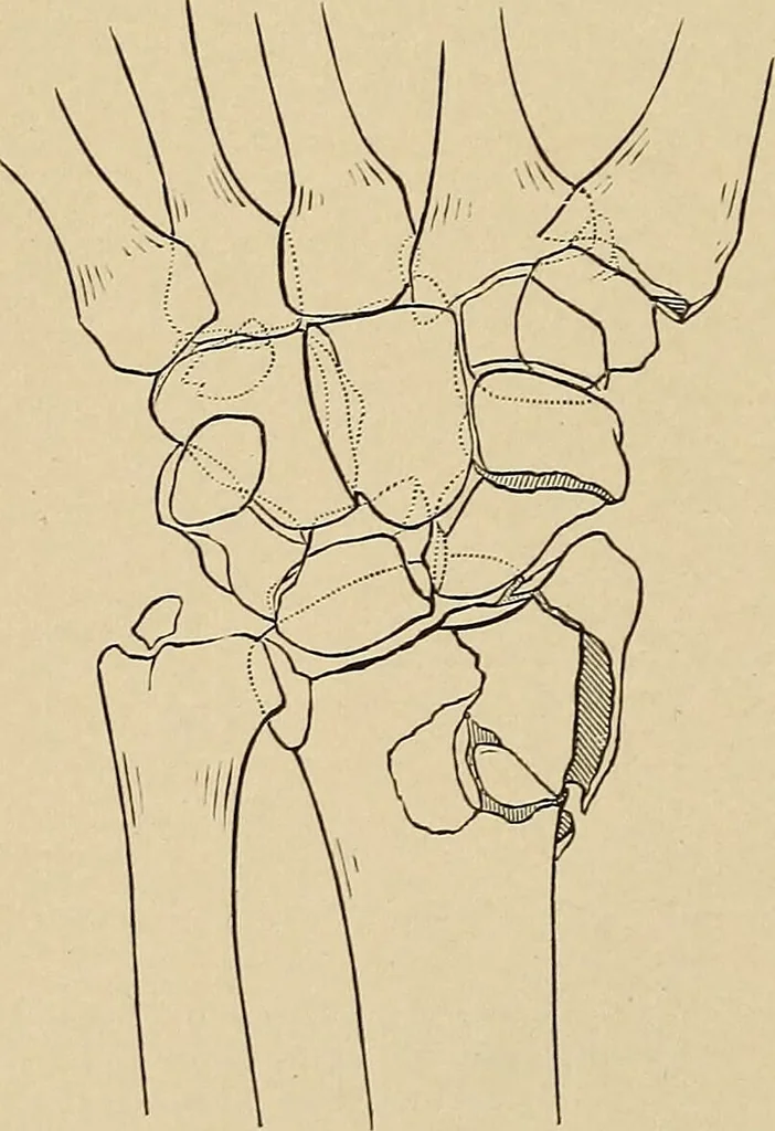 An illustration from Surgical diagnosis / by Edward Martin ... illustrated with 445 engravings and 18 plates in colors and monochrome., 1909, leaf 386