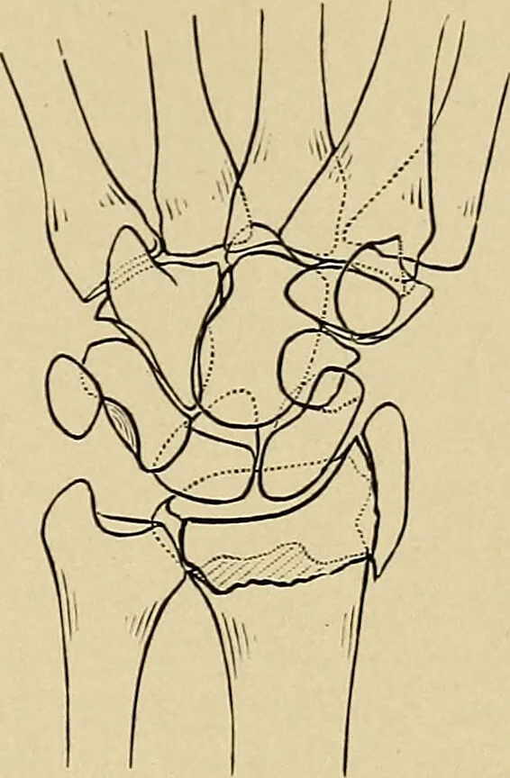 An illustration from Surgical diagnosis / by Edward Martin ... illustrated with 445 engravings and 18 plates in colors and monochrome., 1909, leaf 387