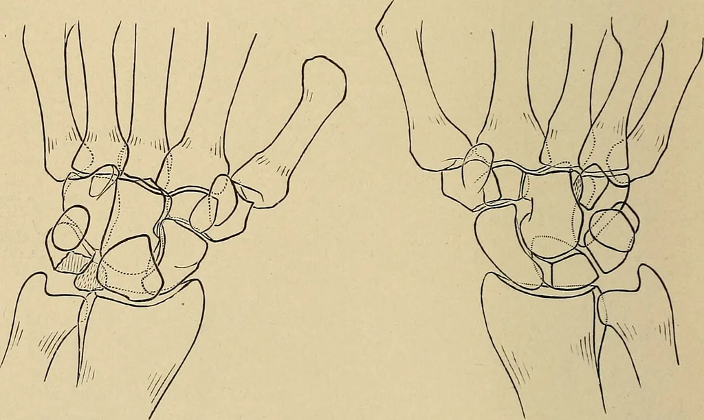 An illustration from Surgical diagnosis / by Edward Martin ... illustrated with 445 engravings and 18 plates in colors and monochrome., 1909, leaf 390