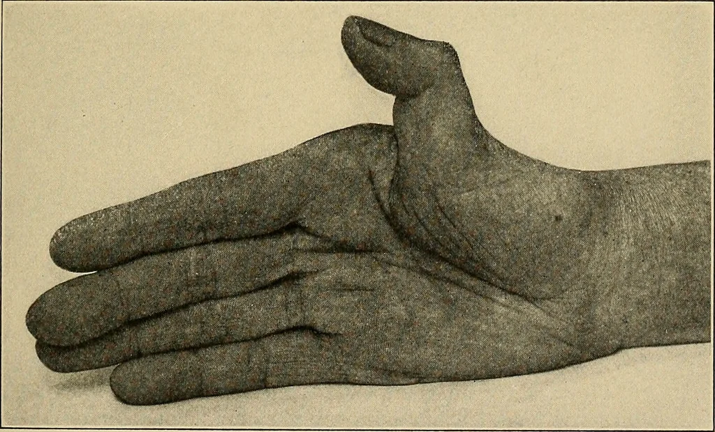 An illustration from Surgical diagnosis / by Edward Martin ... illustrated with 445 engravings and 18 plates in colors and monochrome., 1909, leaf 391