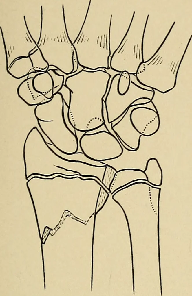 An illustration from Surgical diagnosis / by Edward Martin ... illustrated with 445 engravings and 18 plates in colors and monochrome., 1909, leaf 407