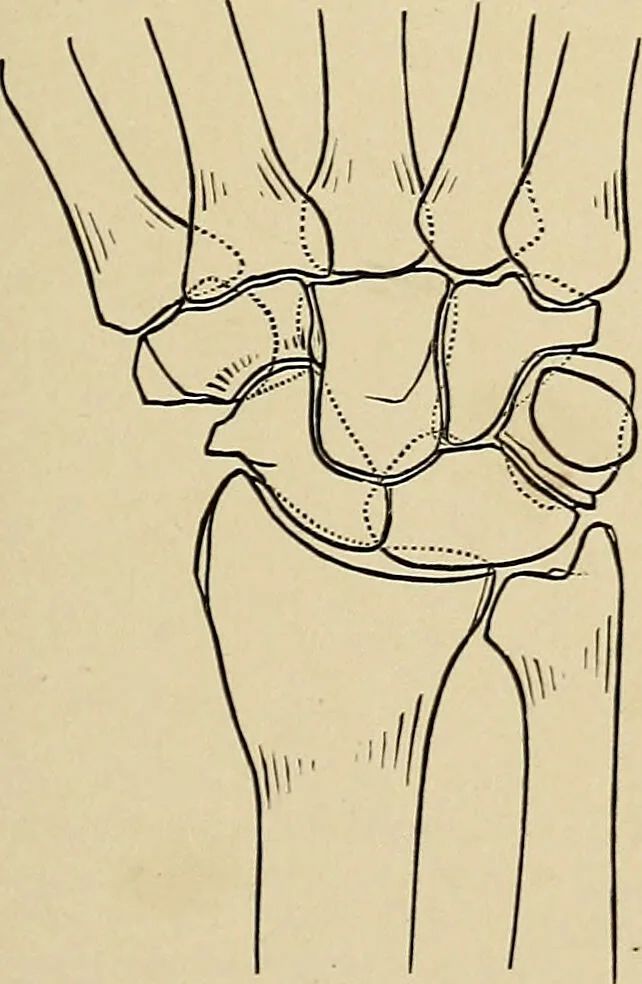 An illustration from Surgical diagnosis / by Edward Martin ... illustrated with 445 engravings and 18 plates in colors and monochrome., 1909, leaf 407