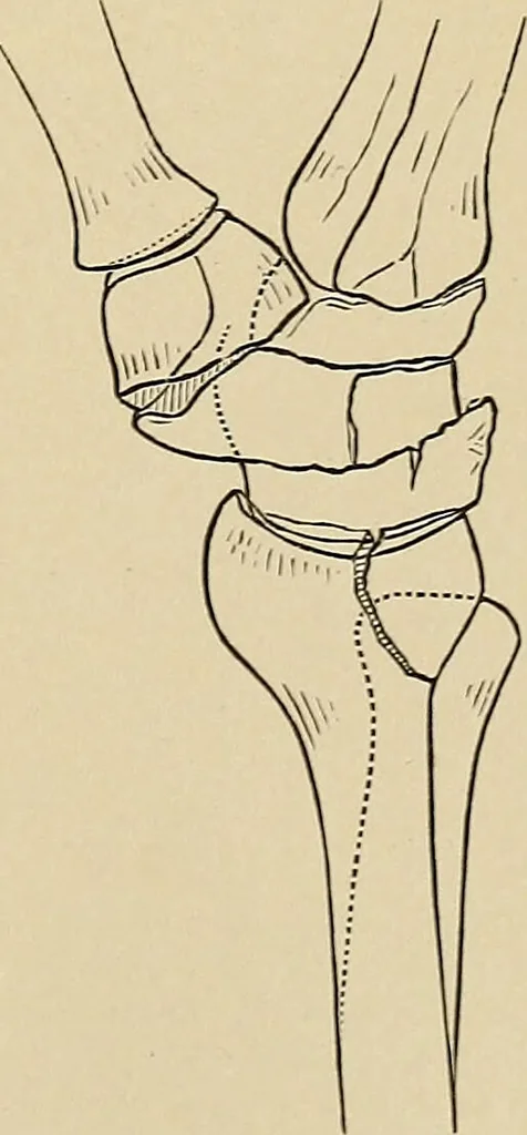 An illustration from Surgical diagnosis / by Edward Martin ... illustrated with 445 engravings and 18 plates in colors and monochrome., 1909, leaf 407