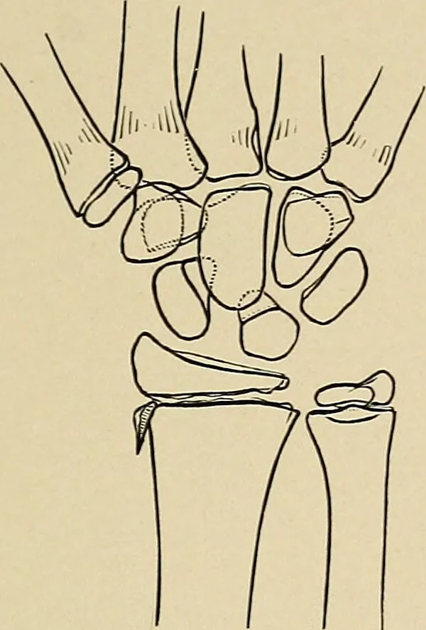 An illustration from Surgical diagnosis / by Edward Martin ... illustrated with 445 engravings and 18 plates in colors and monochrome., 1909, leaf 409