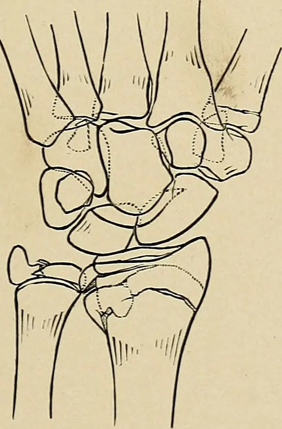 An illustration from Surgical diagnosis / by Edward Martin ... illustrated with 445 engravings and 18 plates in colors and monochrome., 1909, leaf 409