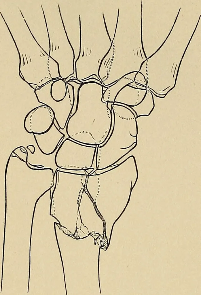 An illustration from Surgical diagnosis / by Edward Martin ... illustrated with 445 engravings and 18 plates in colors and monochrome., 1909, leaf 410