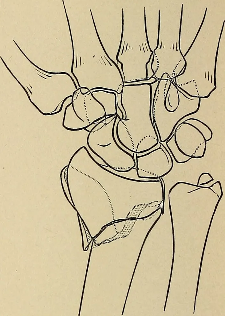 An illustration from Surgical diagnosis / by Edward Martin ... illustrated with 445 engravings and 18 plates in colors and monochrome., 1909, leaf 410