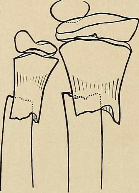 An illustration from Surgical diagnosis / by Edward Martin ... illustrated with 445 engravings and 18 plates in colors and monochrome., 1909, leaf 412