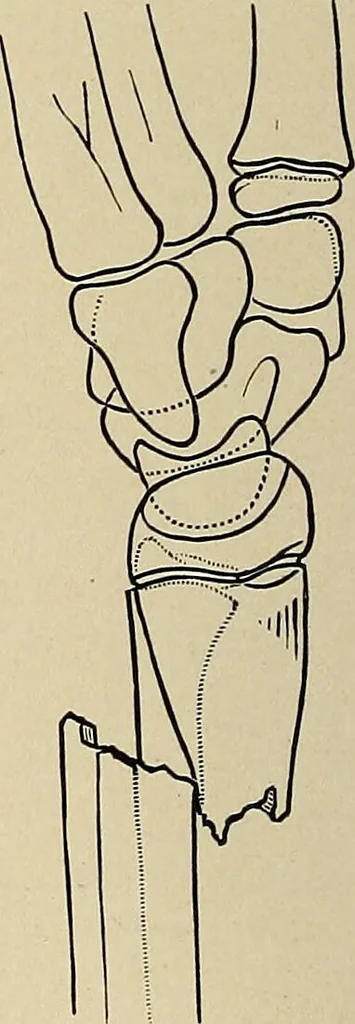 An illustration from Surgical diagnosis / by Edward Martin ... illustrated with 445 engravings and 18 plates in colors and monochrome., 1909, leaf 412