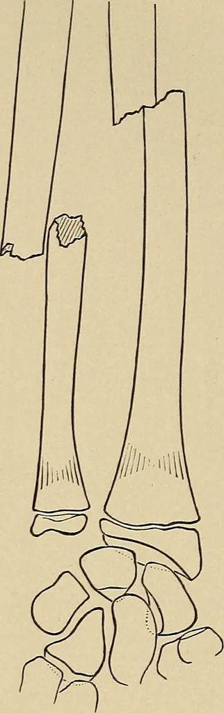 An illustration from Surgical diagnosis / by Edward Martin ... illustrated with 445 engravings and 18 plates in colors and monochrome., 1909, leaf 418