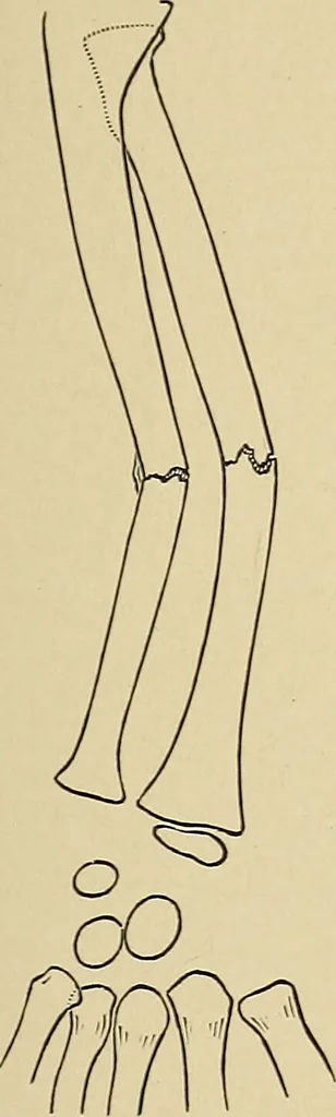 An illustration from Surgical diagnosis / by Edward Martin ... illustrated with 445 engravings and 18 plates in colors and monochrome., 1909, leaf 419